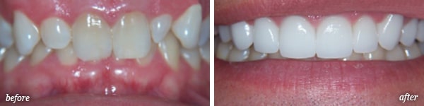 Pittston cosmetic dentistry procedure before and after for Brian