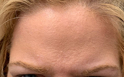 After photo of the forehead of a Botox and dermal filler patient.