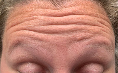 Before photo of the forehead of a Botox and dermal filler patient.